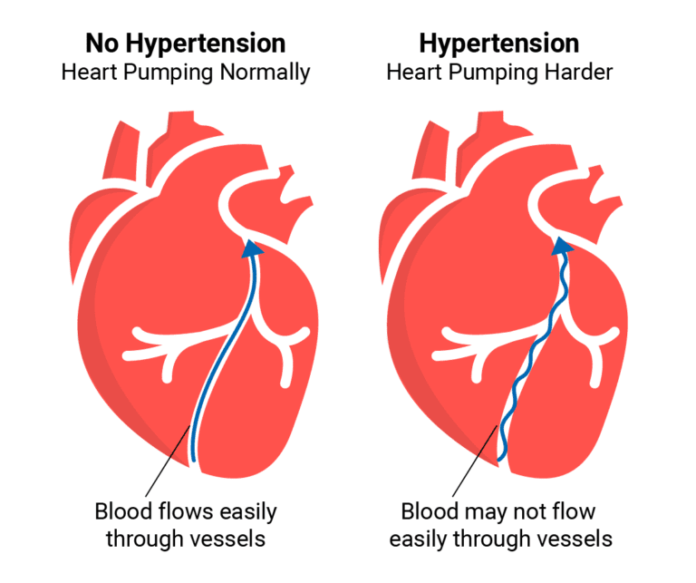 A diagram of two different types of heart pumping.